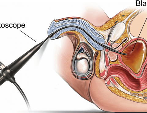 Best Cystoscopy Surgery in Thailand