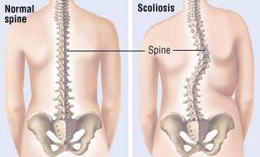Best Scoliosis Treatment in Thailand