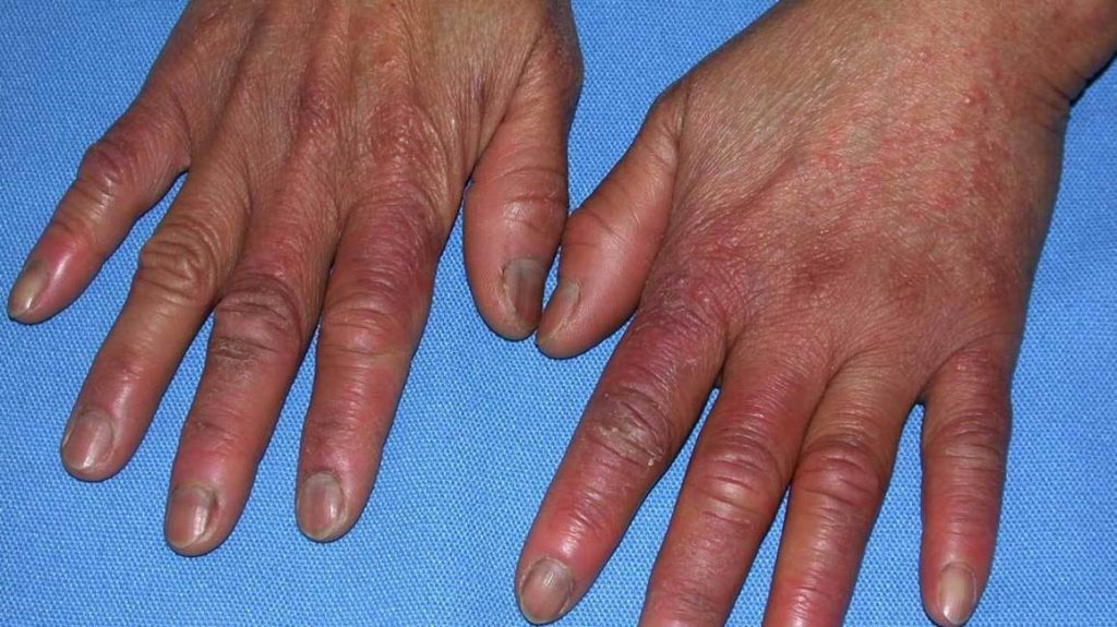 chilblains-treament-in-thailand-almurshidi-medical-tourism-best