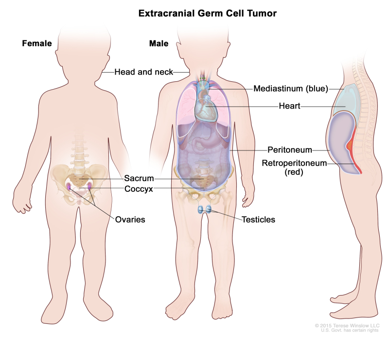 Best Germ Cell Tumor Treatment in Thailand