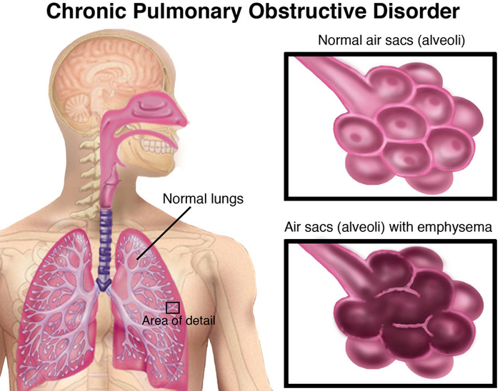Chronic Obstructive Pulmonary Disease Treatment in Thailand