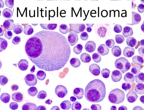 Multiple Myeloma Treatment in Thailand