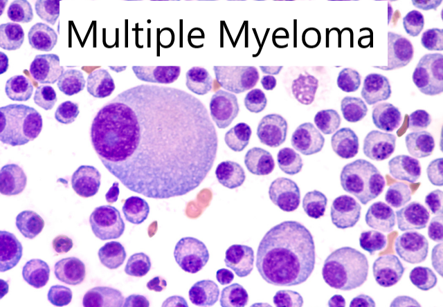 Multiple Myeloma Treatment in Thailand