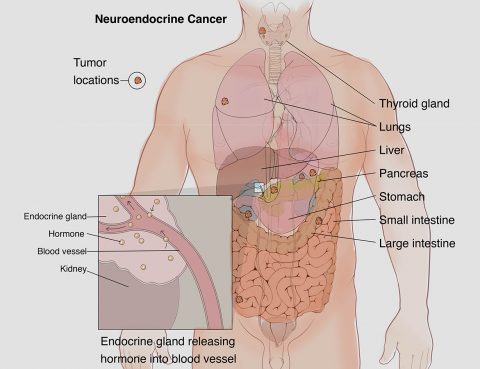 Neuroendocrine Tumor Treatment in Thailand