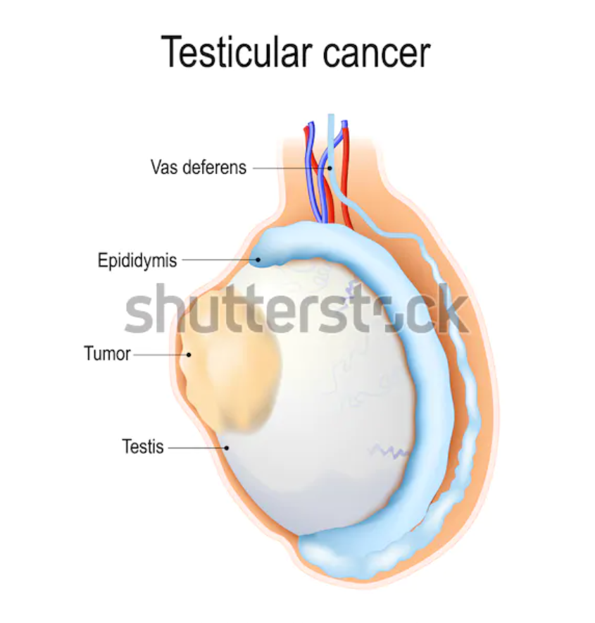 Testicular Cancer Treatment in Thailand