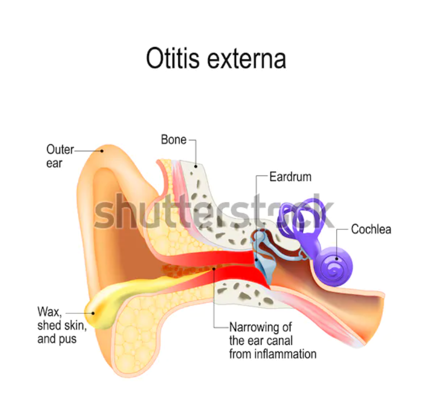 Otitis Externa Treatment in Thailand