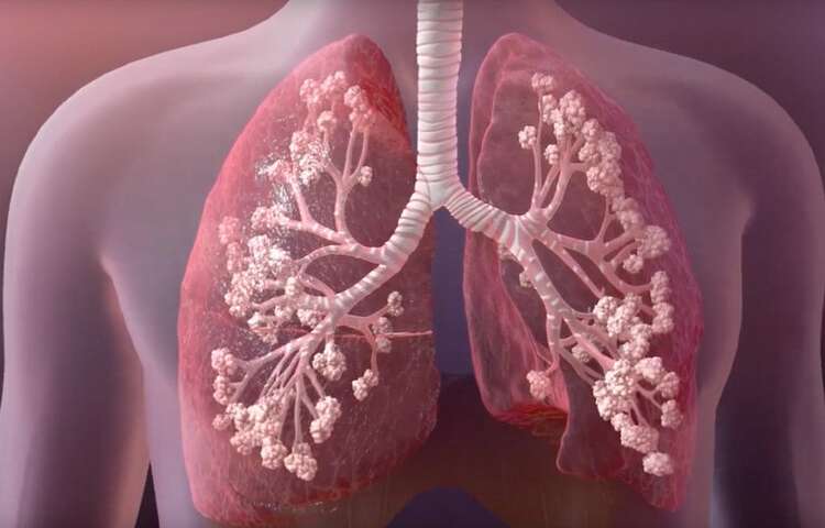 Best Cystic Fibrosis Treatment in Thailand