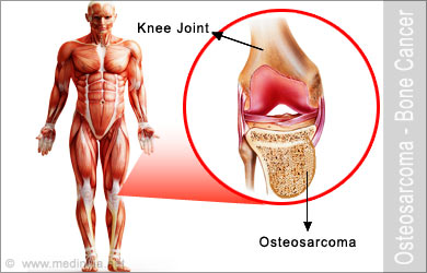 Best Osteosarcoma Treatment in Thailand