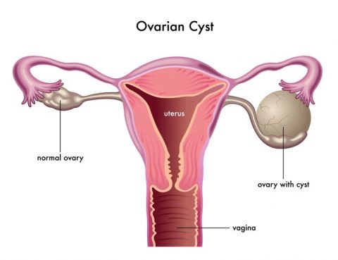 Ovarian Cyst Treatment in Thailand
