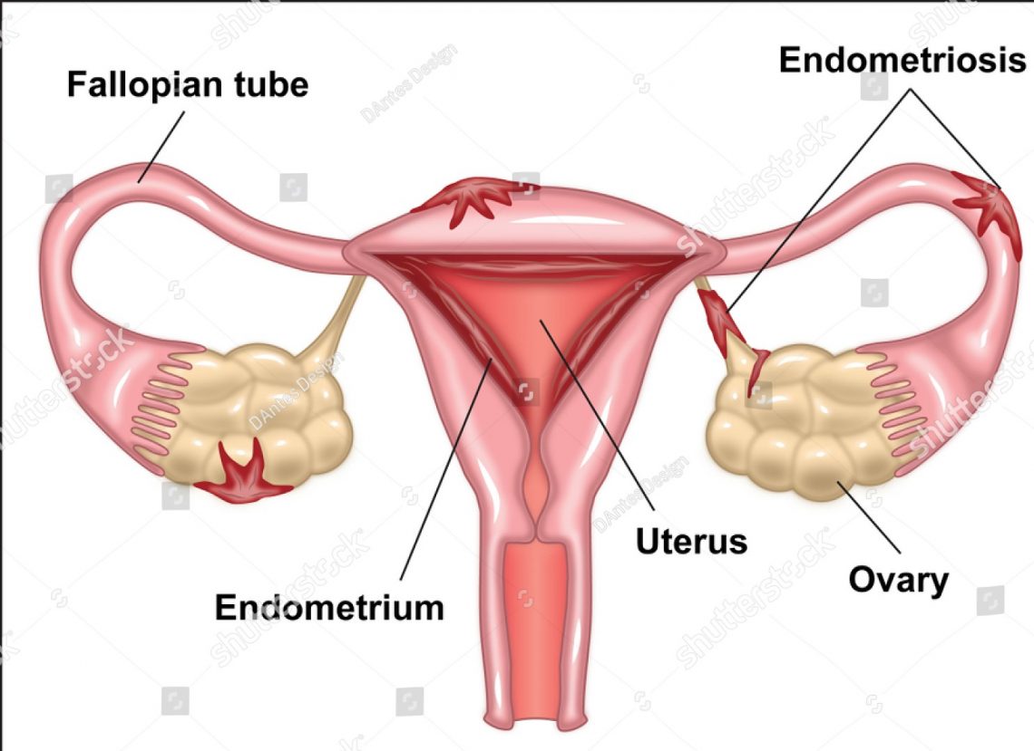 Endometriosis Treatment in Thailand