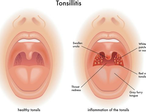 Tonsillitis Treatment in Thailand