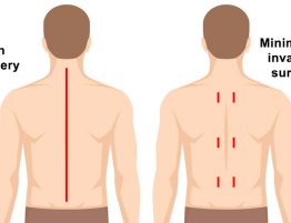 Minimally Invasive Spine Surgery in Thailand