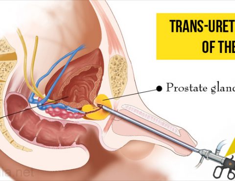 Transurethral Resection of the Prostate Surgery in Thailand