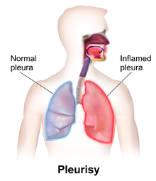 Pleurisy Diagnosis and Treatment in Thailand