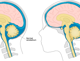 Chiari Malformation Treatment in Thailand Archives - Almurshidi Medical ...