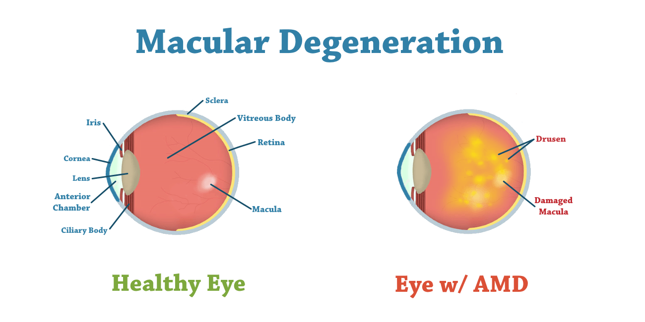 Macular Degeneration Treatment in Thailand Almurshidi