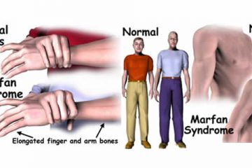 Marfan Syndrome Archives - Almurshidi Medical Tourism Agency ...