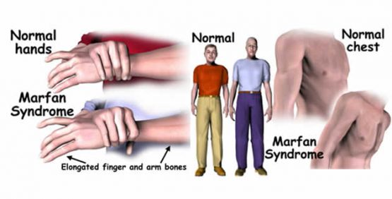 Marfan syndrome что это