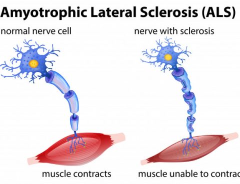 Amyotrophic Lateral Sclerosis Treatment in Thailand