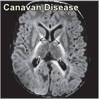 Canavan Disease Treatment in Thailand