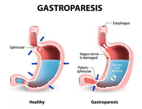 Gastroparesis Treatment in Thailand