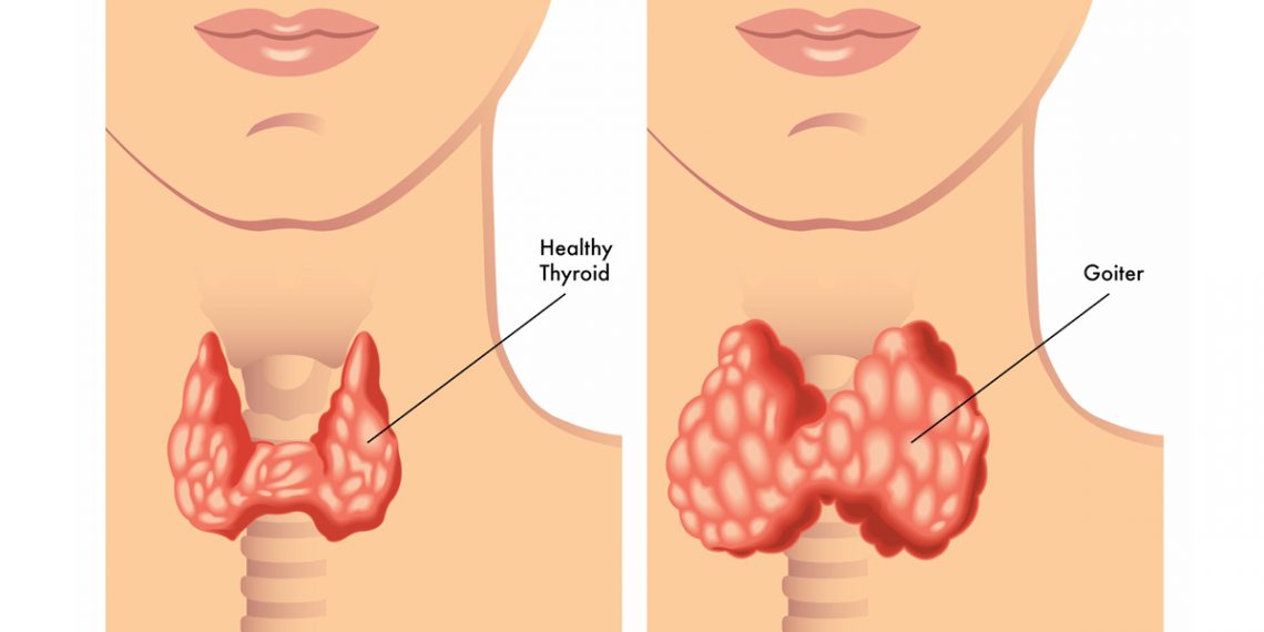 Hypothyroidism Treatment in Thailand