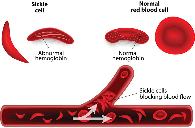 blood disease that starts with mylio