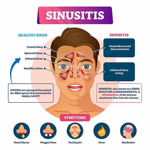 Sinusitis Treatment in Thailand