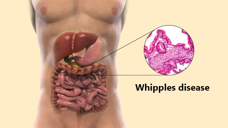 Whipple Disease Treatment in Thailand