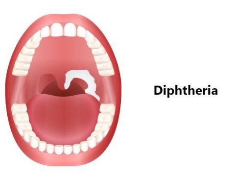 Diphtheria Treatment in Thailand