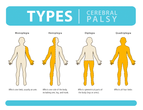 Cerebral Palsy Treatment in Thailand