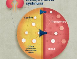 Cystinuria Diagnosis and Treatment in Thailand