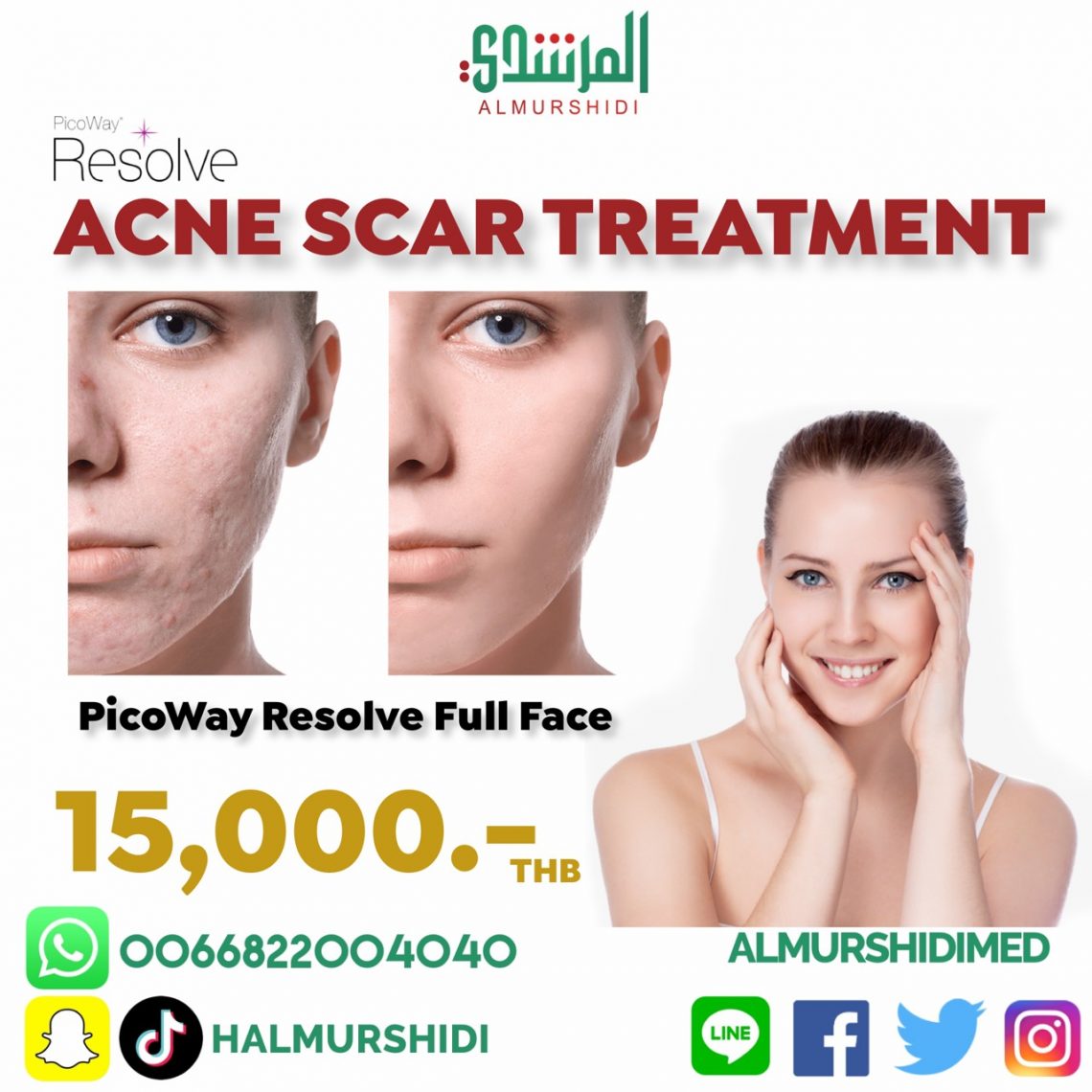 Best Acne Scar Removal in Thailand