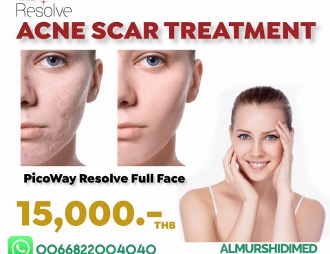 Best Acne Scar Removal in Thailand