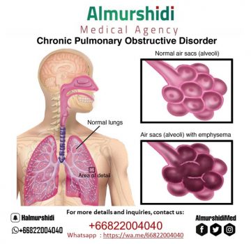 Chronic Obstructive Pulmonary Disease Treatment