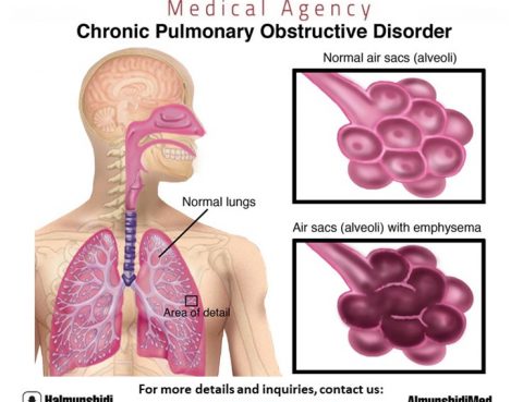 Chronic Obstructive Pulmonary Disease Treatment