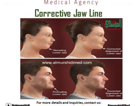 Corrective Jaw Line