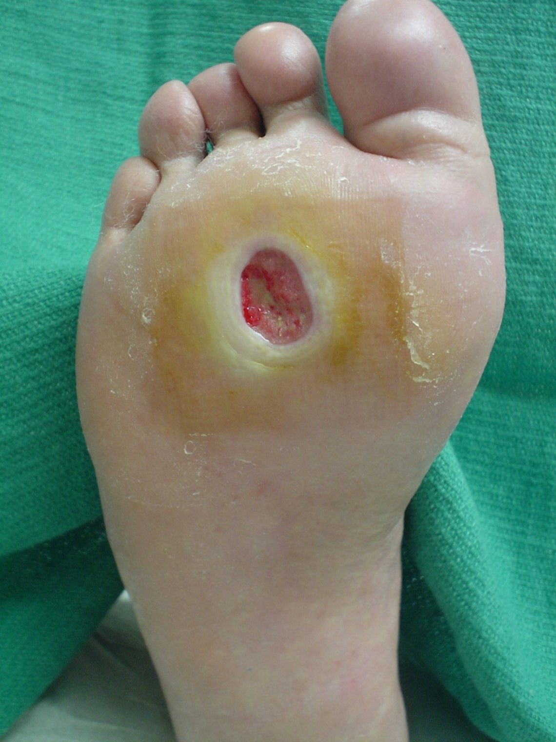 Diabetic Foot Ulcer
