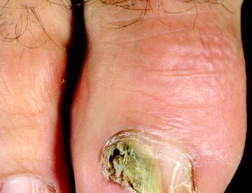 Nail Fungal Infection