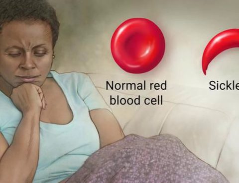 Sickle Cell Anemia