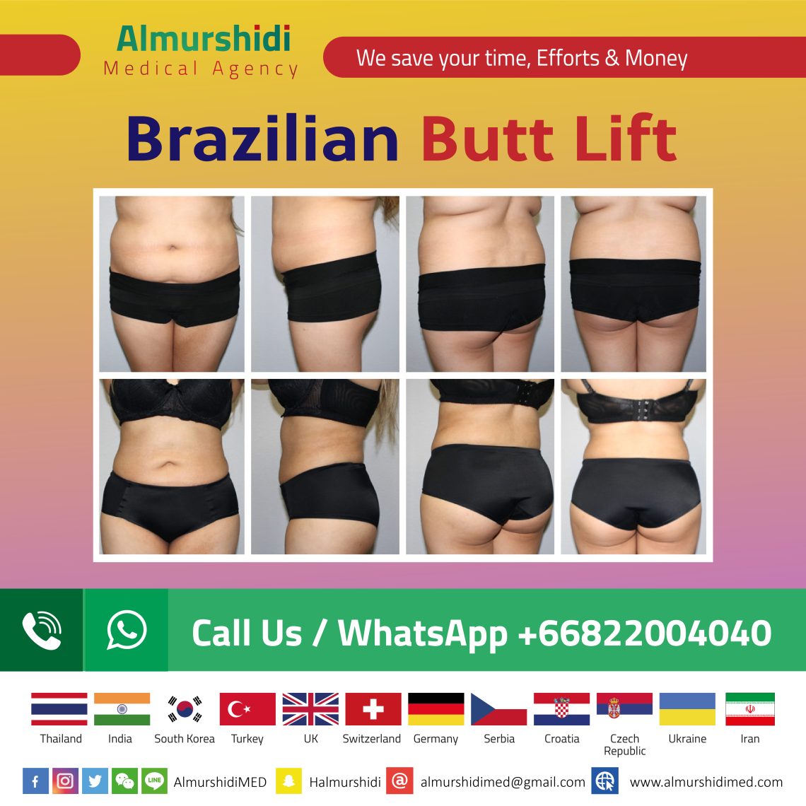 Brazilian _Butt_lift