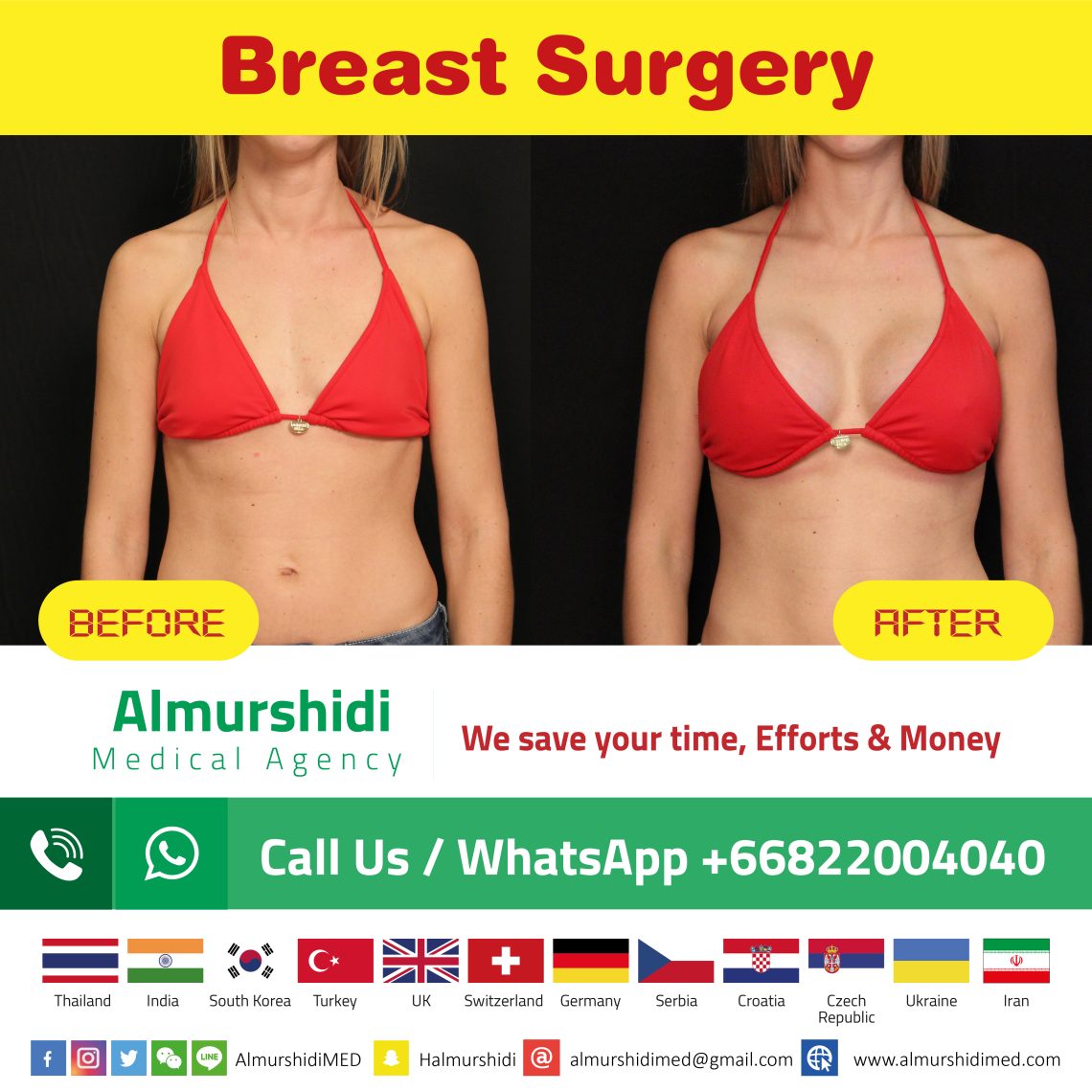 breast surgery