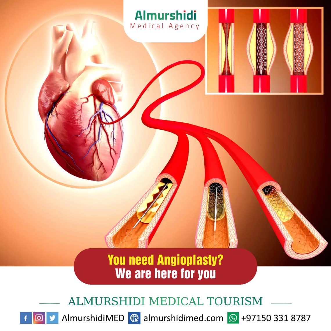 angioplasty