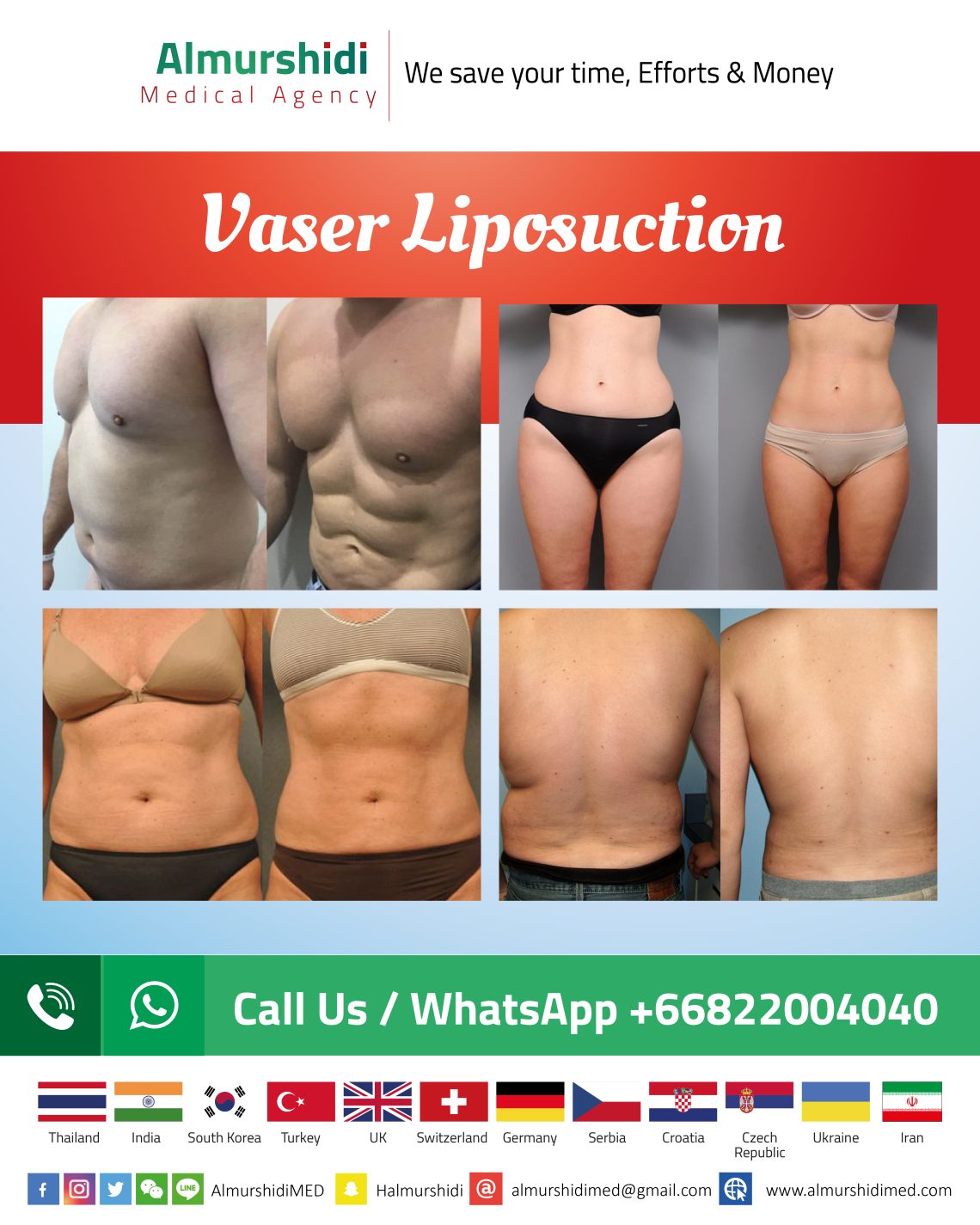 vaser_liposuction