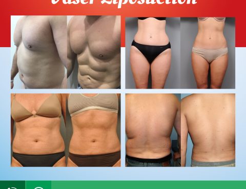 vaser_liposuction