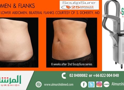 sculpsure