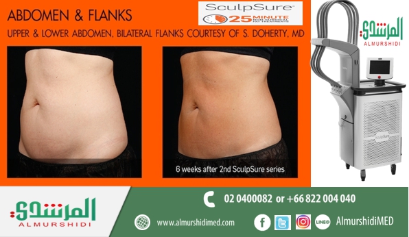 sculpsure