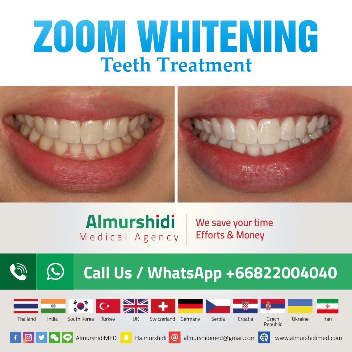 zoom whitening teeth