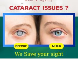 cataract issues