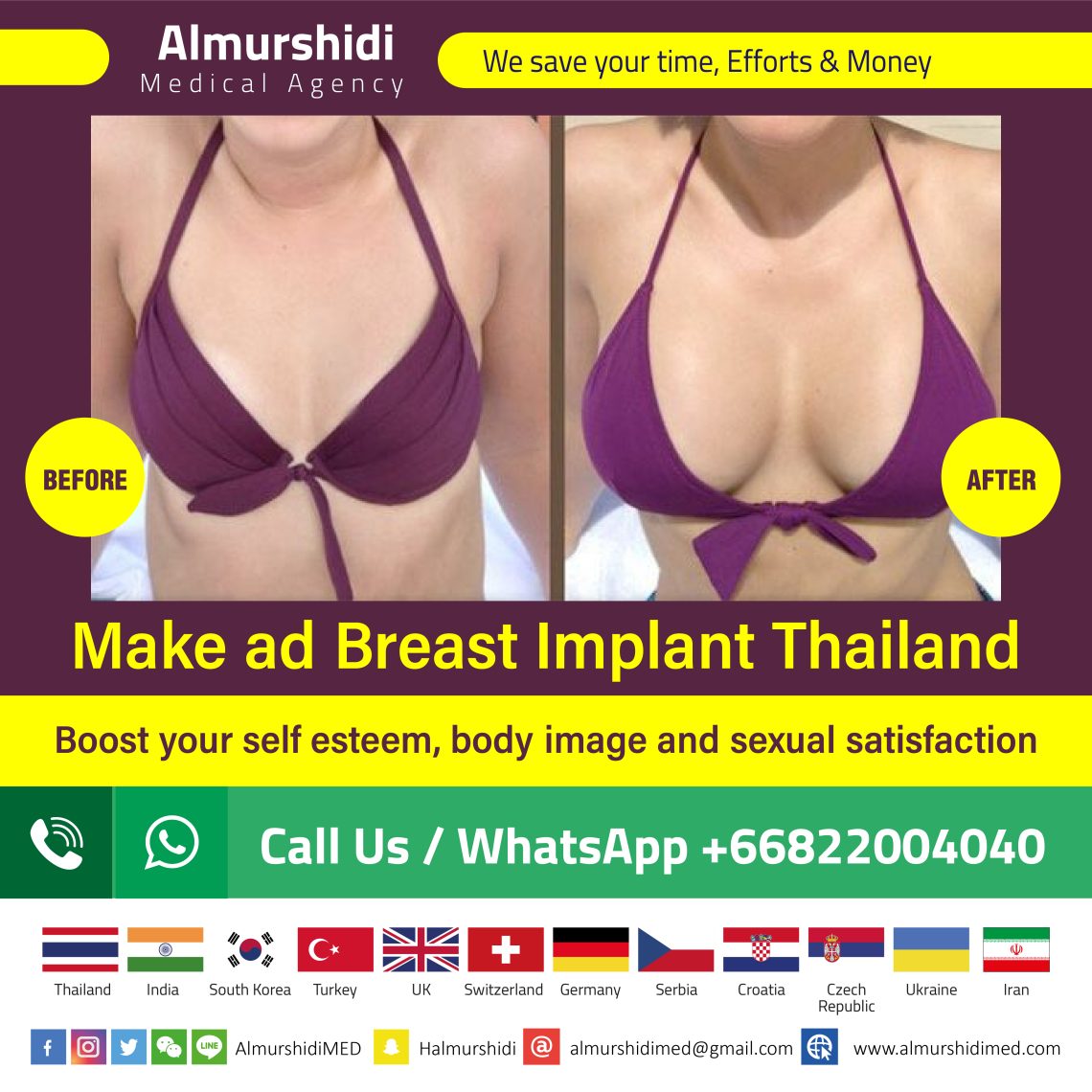 breast implant